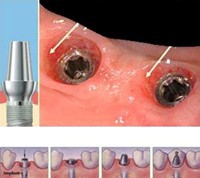 Postopek vstavljanja zobnega implantata