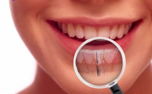 Zobni vsadki brez operacije